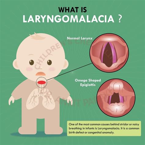 signs of laryngomalacia